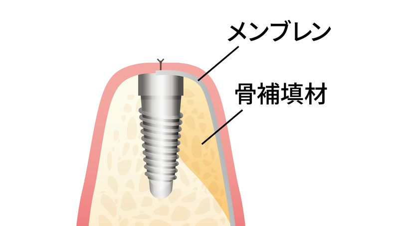 名古屋市名東区の骨造成（骨増生）・骨移植