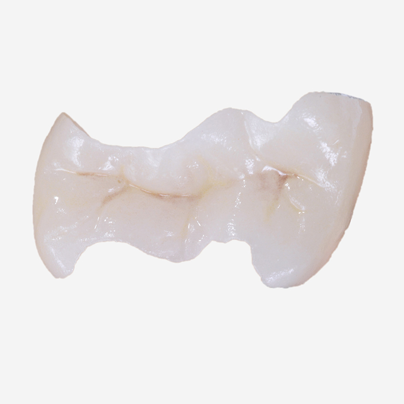 名古屋市名東区の虫歯治療